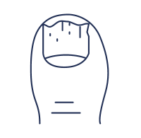 Onicomicosis​ Consultas de Dermatología por Telemedicina