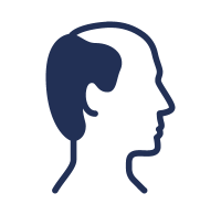 alopecia generalizada y localizada ​ Consultas de Dermatología por Telemedicina